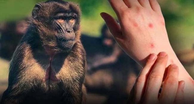থাইল্যান্ডে এমপক্সের নতুন ধরনের সন্ধান পাওয়া গেছে