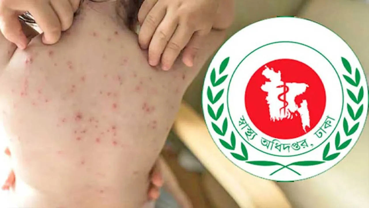 হাম ও হামের উপসর্গে আরো ১৭ শিশুর মৃত্যু