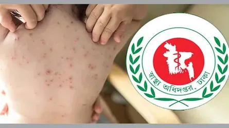 সন্দেহজনক ছয়সহ হামে ১০ জনের মৃত্যু, আক্রান্ত ১২৬৮