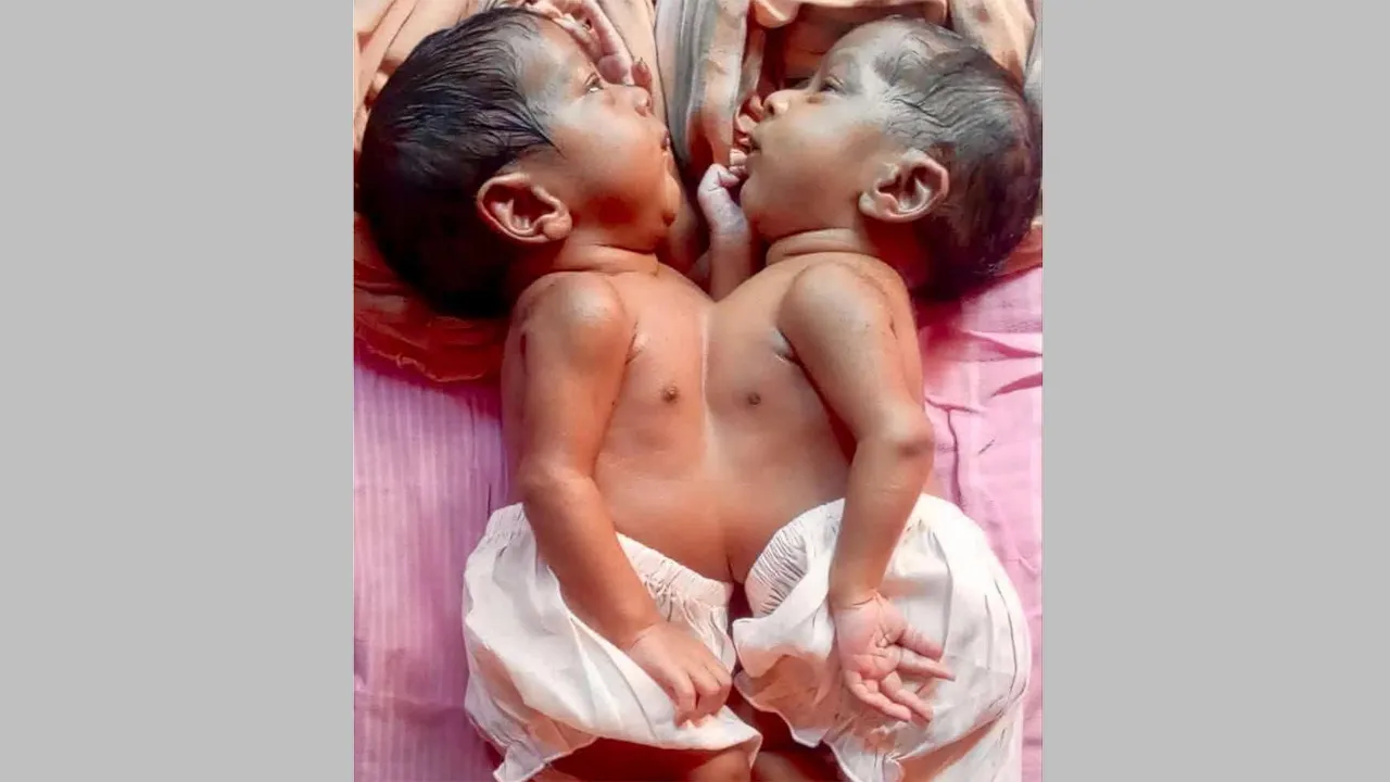 একই কবরে দাফন করা হলো জোড়া লাগা যমজ দুই বোনকে