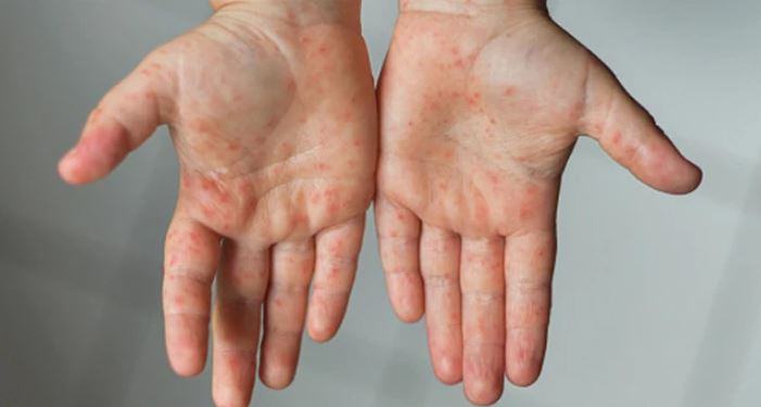 Measles