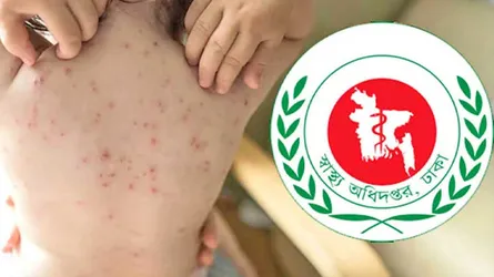 সারা দেশে হামের উপসর্গে আরো ৭ জনের মৃত্যু