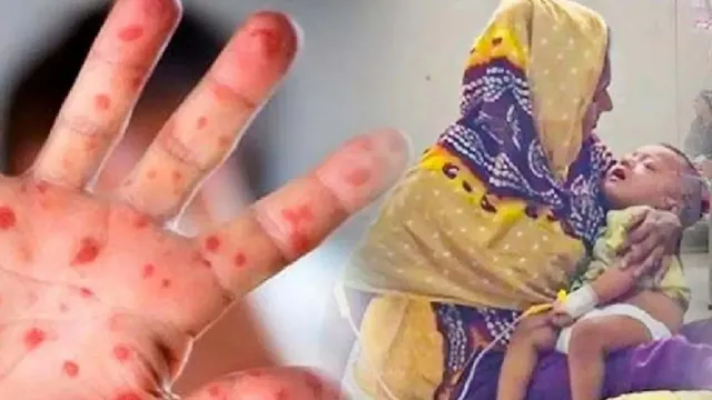 হাম সন্দেহে আরো ১১ শিশুর মৃত্যু