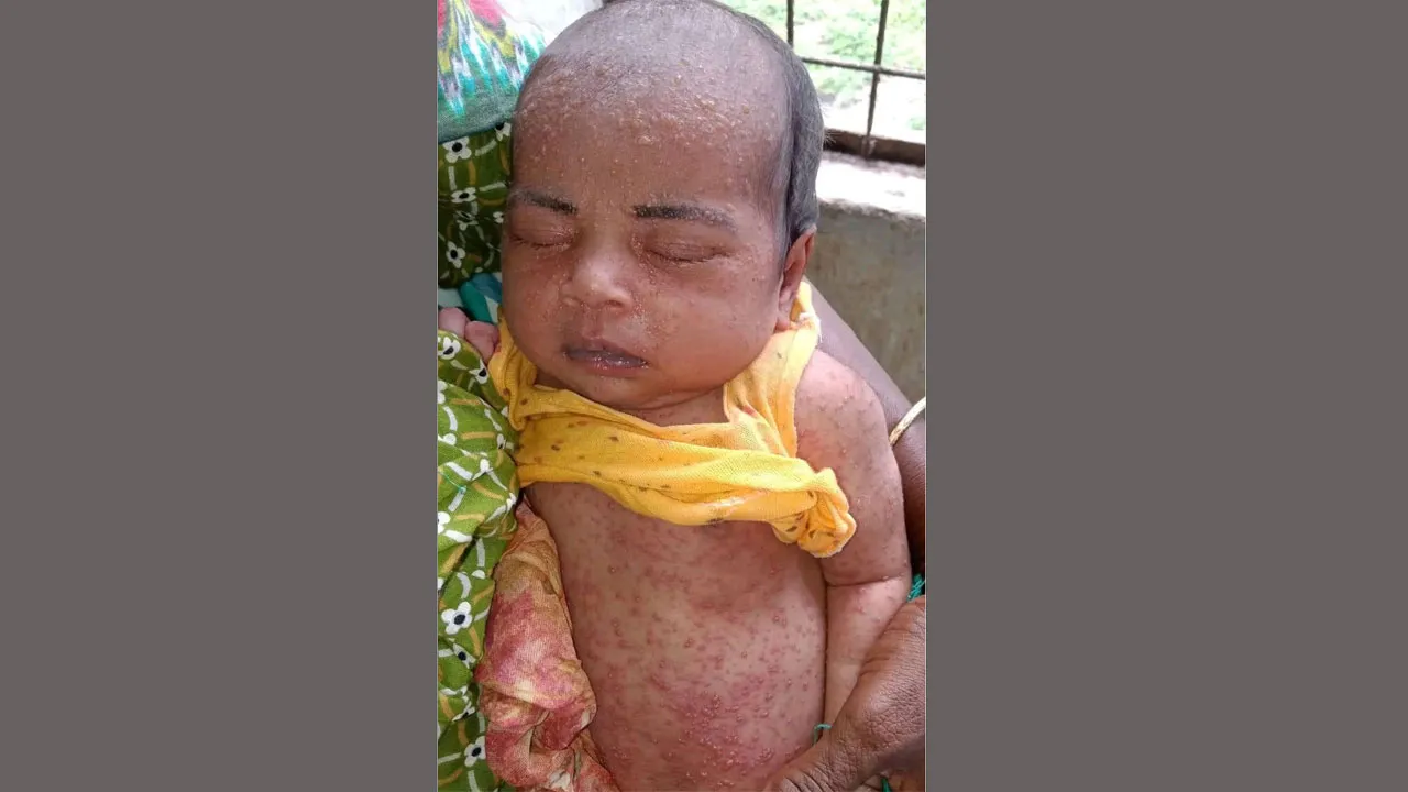 নীলফামারীতে হামের উপসর্গ, নবজাতকের মৃত্যু