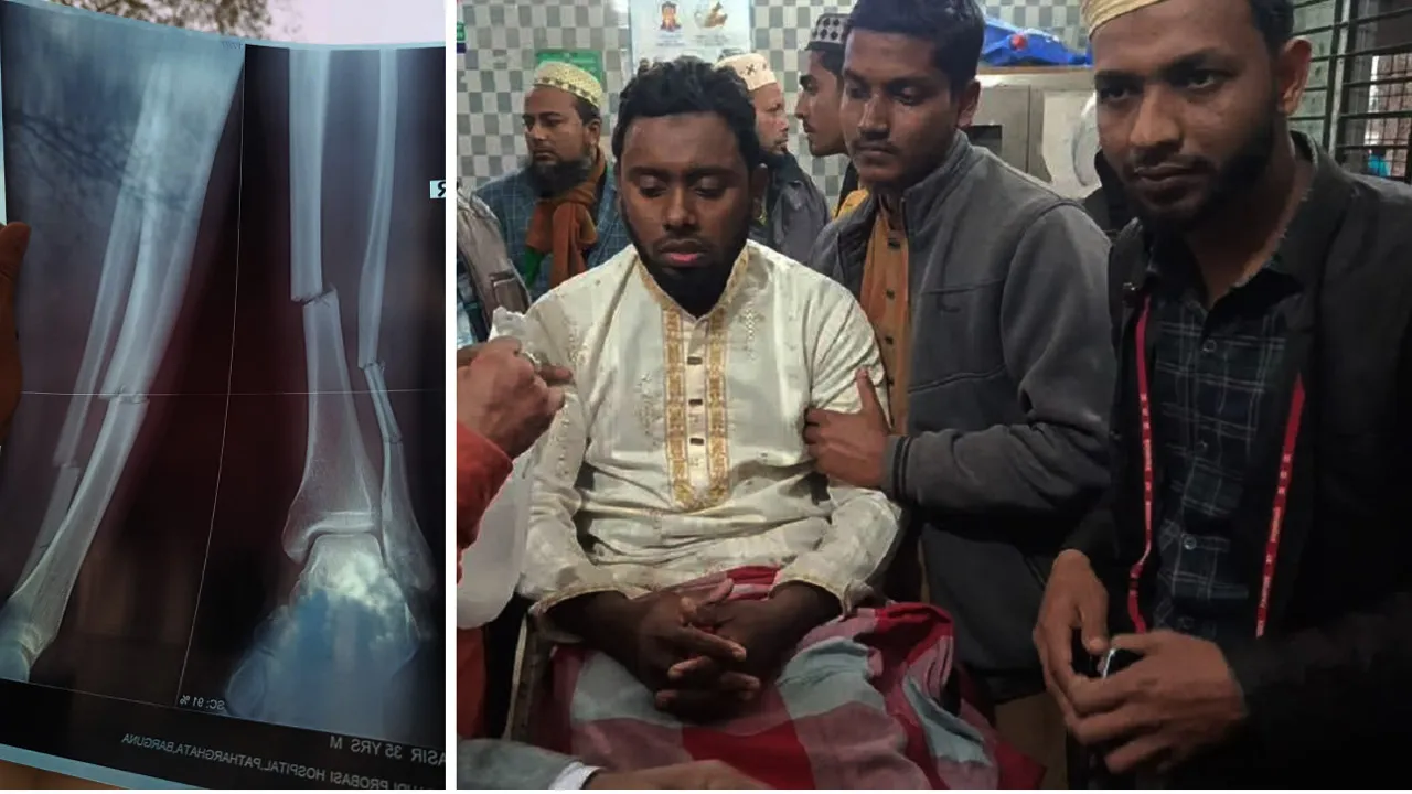 পাথরঘাটায় জামায়াত নেতার ওপর হামলা চালিয়ে পা ভেঙে দেয়ার অভিযোগ বিএনপি কর্মীর বিরুদ্ধে