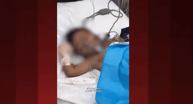 ইসরাইলি অবিস্ফোরিত বোমায় আহত গাজার শিশু