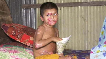 অজানা চর্মরোগ, চিকিৎসার অভাবে হারাতে বসেছে শিশু নুহামনির শৈশব