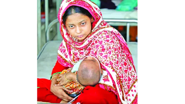 ২০২১ থেকেই বাড়ছিল হাম, ব্যবস্থা না নেয়ায় বর্তমানের মহামারী