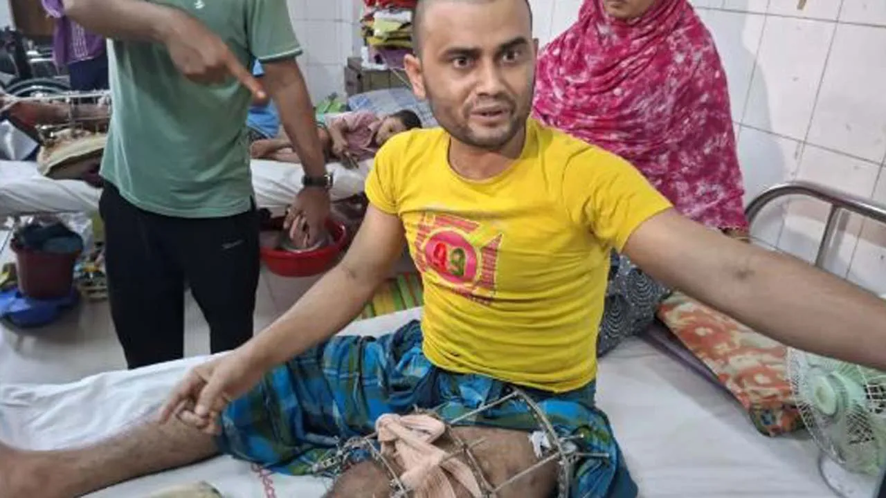 পঙ্গু হাসপাতালে চিকিৎসা না পাওয়ার অভিযোগ জুলাই আহতদের, ক্ষোভ প্রকাশ
