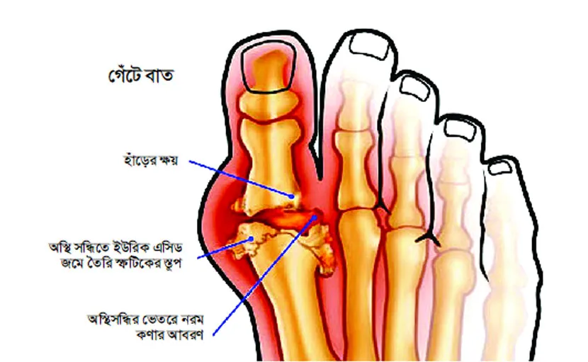 রমজানে গেঁটে বাতের রোগীর যতœ