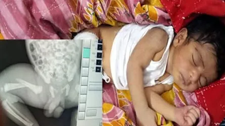 পটুয়াখালীতে নার্সের বিরুদ্ধে নবজাতকের পা ভাঙার অভিযোগ