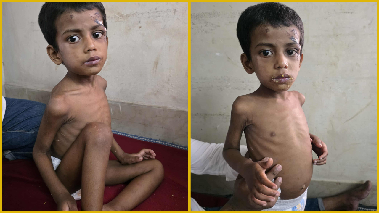 অমানবিক নির্যাতনের শিকার চার বছর বয়সী শিশু হোসেন
