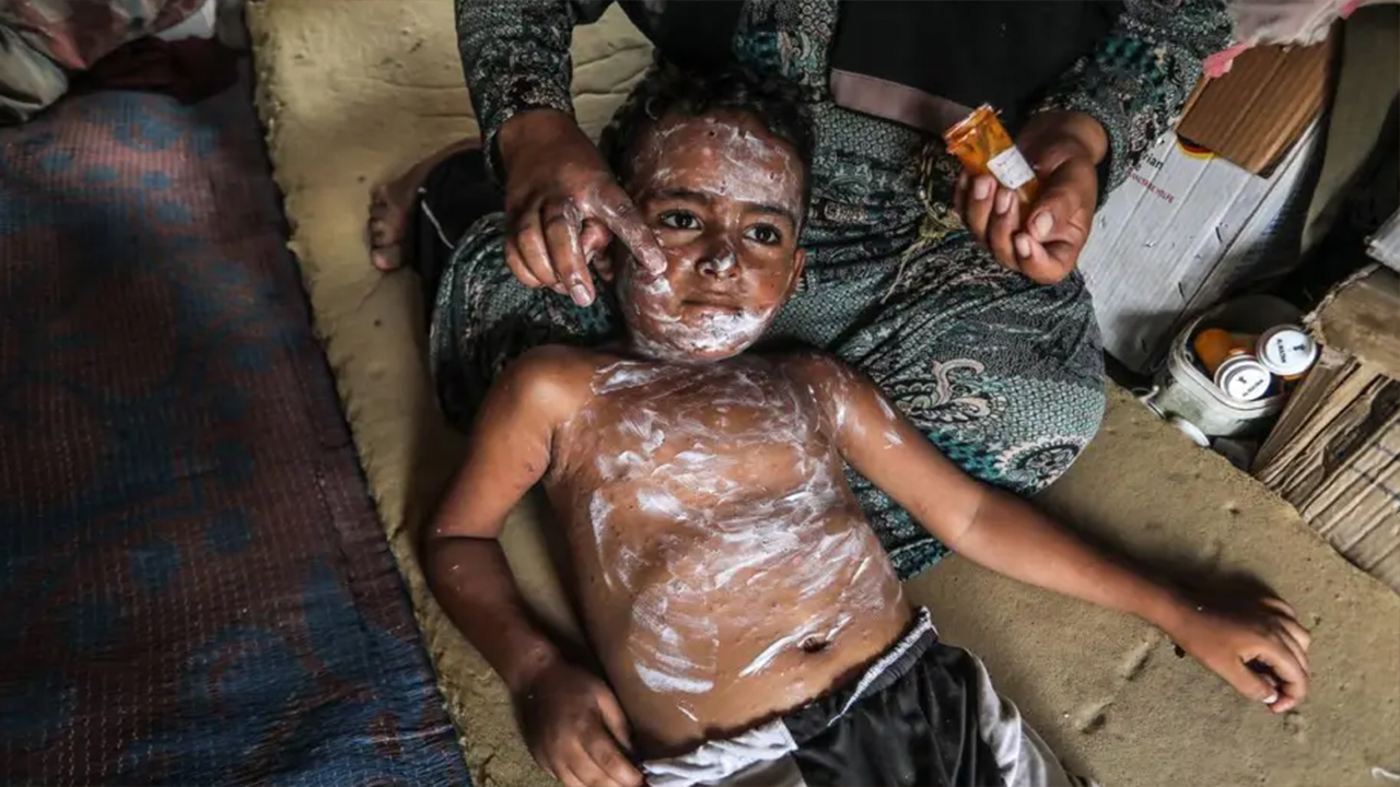জলবসন্তে আক্রান্ত ফিলিস্তিনি এক শিশু