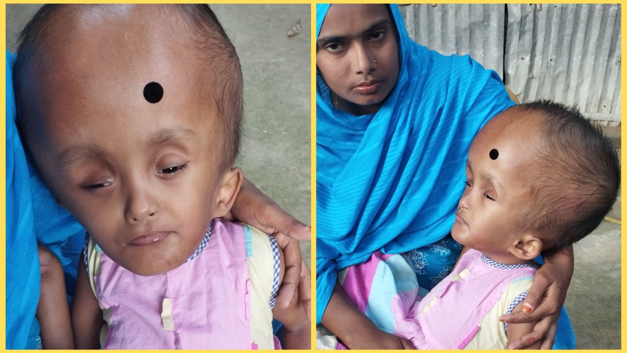 হাইড্রোসেফালাস রোগে আক্রান্ত শিশু আয়শা