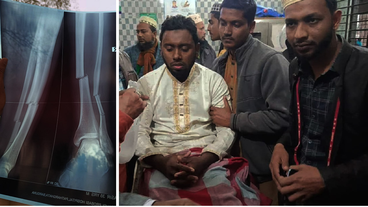 পাথরঘাটায় জামায়াত নেতার ওপর হামলা চালিয়ে পা ভেঙে দেয়ার অভিযোগ বিএনপি কর্মীর বিরুদ্ধে