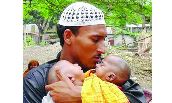 জোড়া লাগা শিশুর অস্ত্রোপচারের বাধা আর্থিক সঙ্কট
