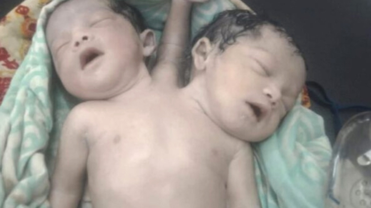দুই মাথা ও তিন হাত, বিরল গঠনের এক নবজাতকের জন্ম