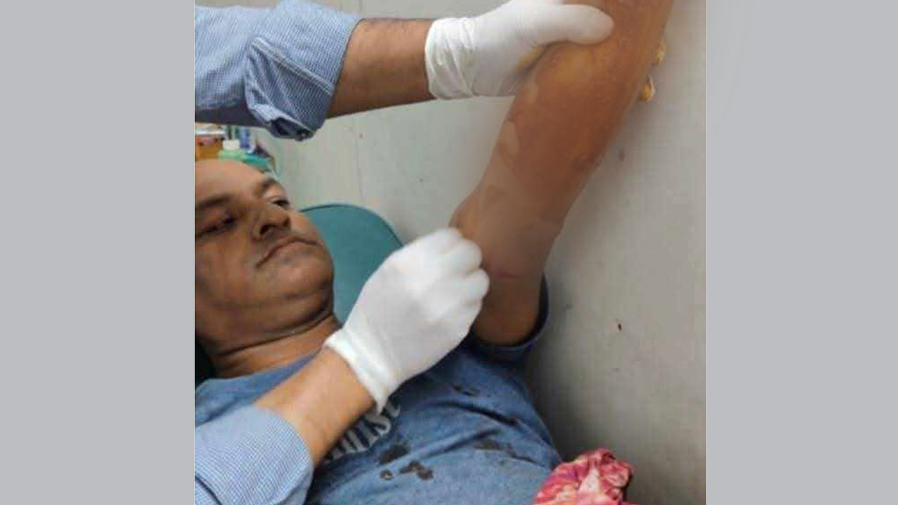 বিস্ফোরণে আহত মোহাম্মদ জুয়েল (ছবিতে হাতের ক্ষতিগ্রস্ত অংশ ব্লার করে দেয়া হয়েছে)